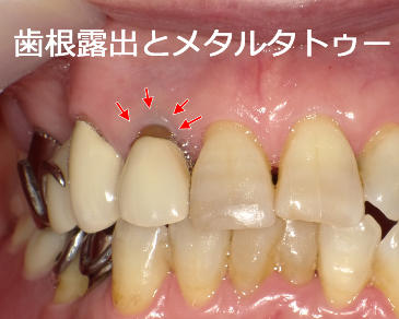歯根露出とメタルタトゥー