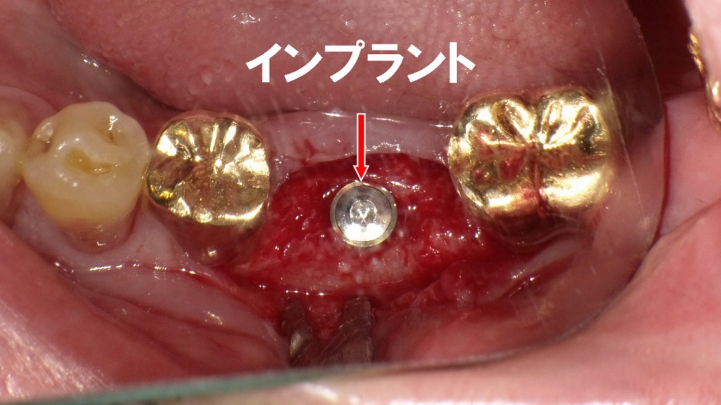 左下6番（第1大臼歯）にインプラント埋入