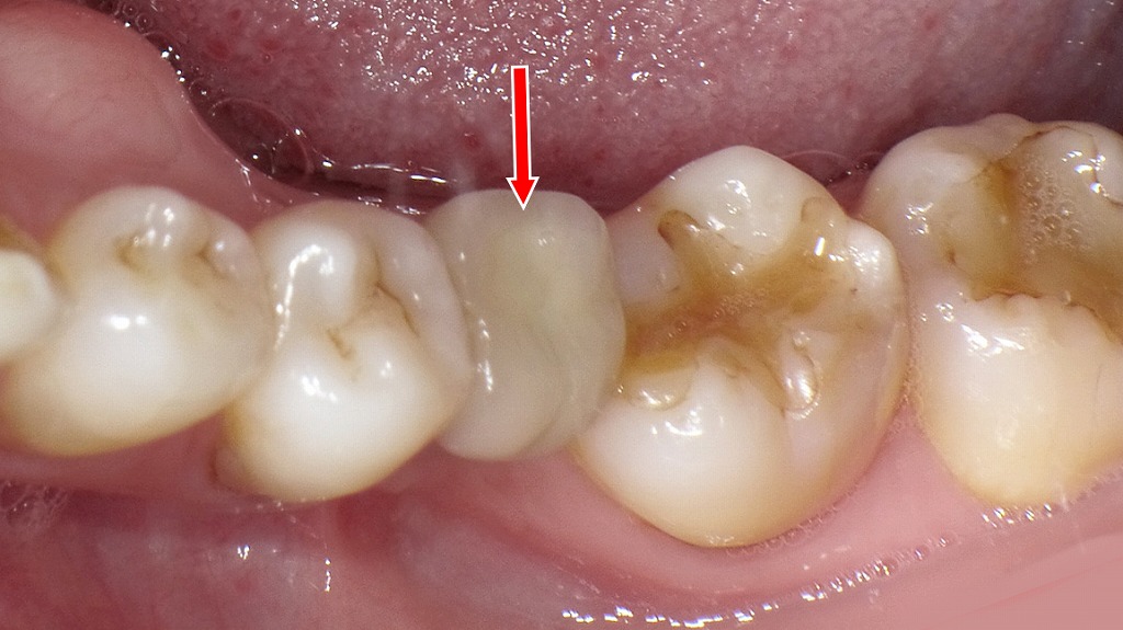 フルジルコニアクラウン装着後の口腔内写真