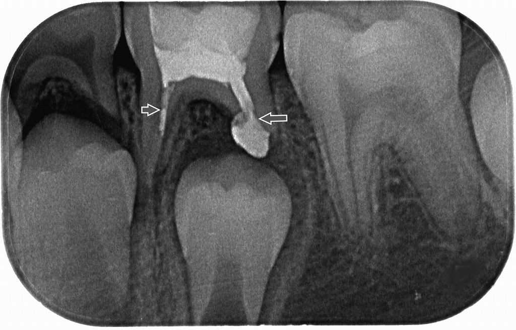 乳歯Eの根管治療中のX線画像。根の中の感染を除去し、薬剤を充填している様子です。矢印は根管内の充填材を示しています。