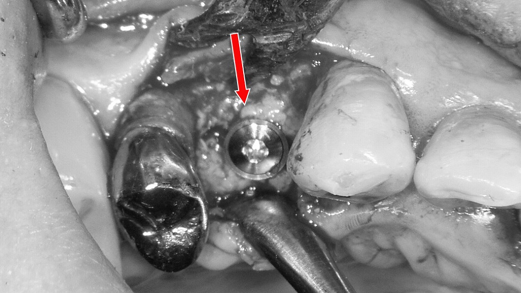 上顎４番欠損にインプラント埋入
