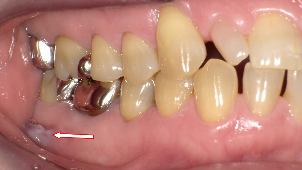 症例1：根尖性歯周炎（フィステル）