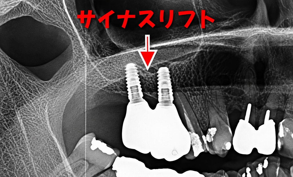 インプラント埋入
