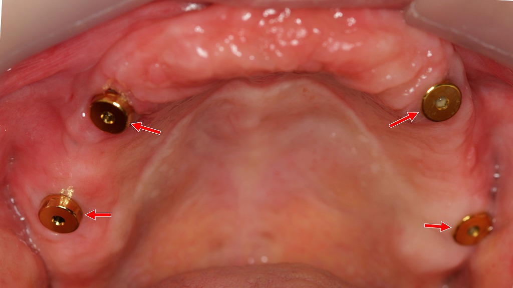 インプラントに4つの磁性アタッチメントを装着した症例