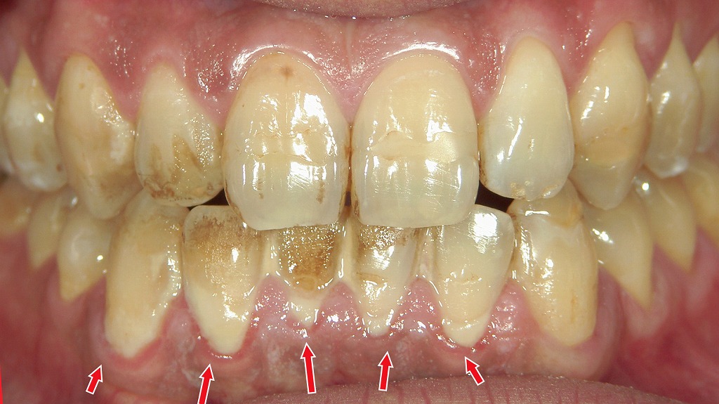 ドブ臭い口臭の正体：大量の歯垢が発生源に