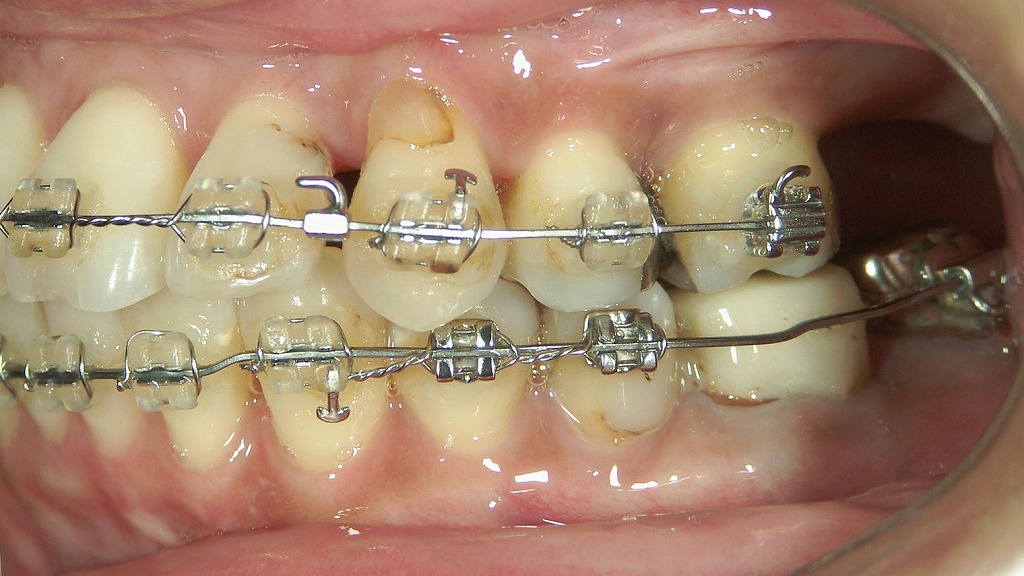  ワイヤー矯正（表側）