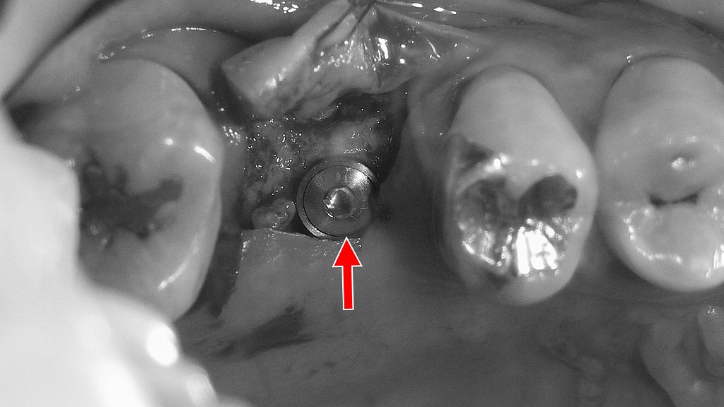上顎6番部インプラント埋入手術（術中）