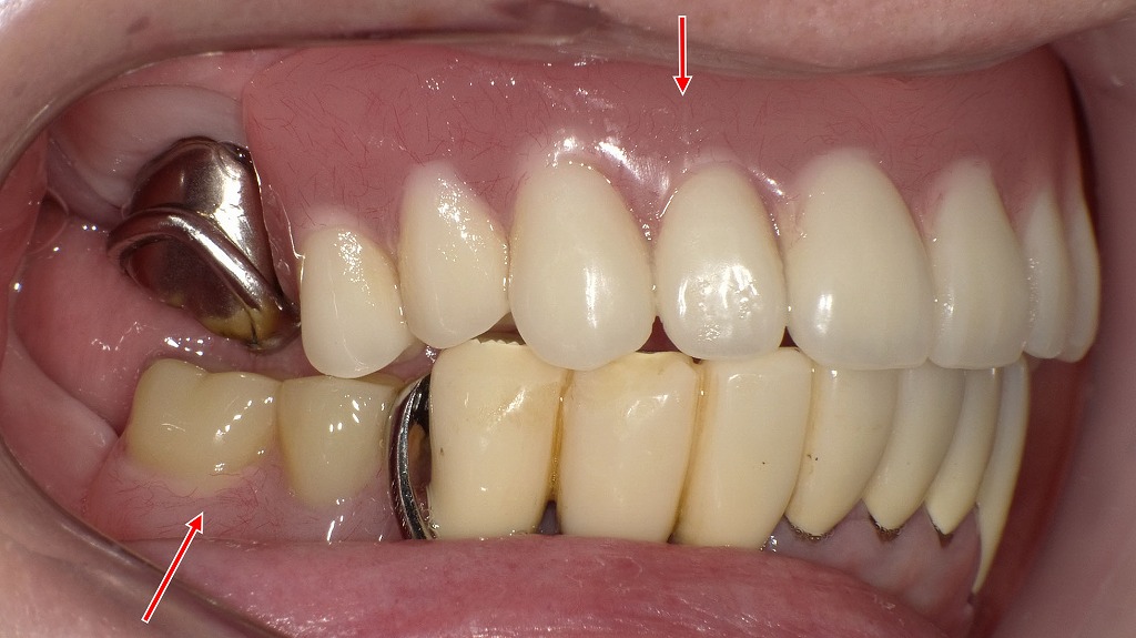 入れ歯をつけたまま寝るべき例外とは？｜上下に保険のクラスプ義歯を装着した症例