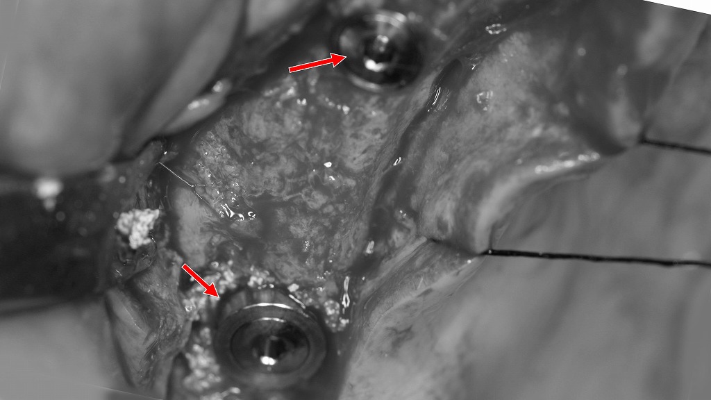 無歯顎に対するインプラントオーバーデンチャー治療
