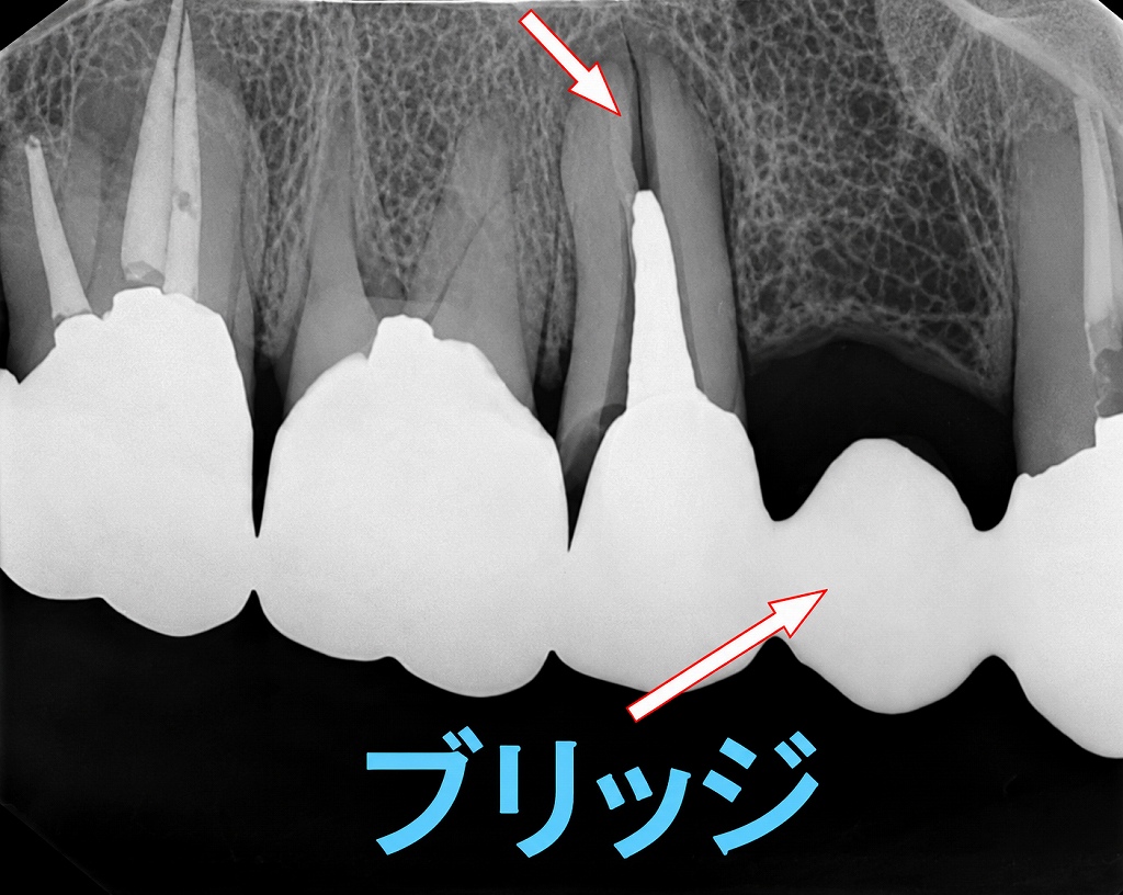 上顎5番が歯根破折