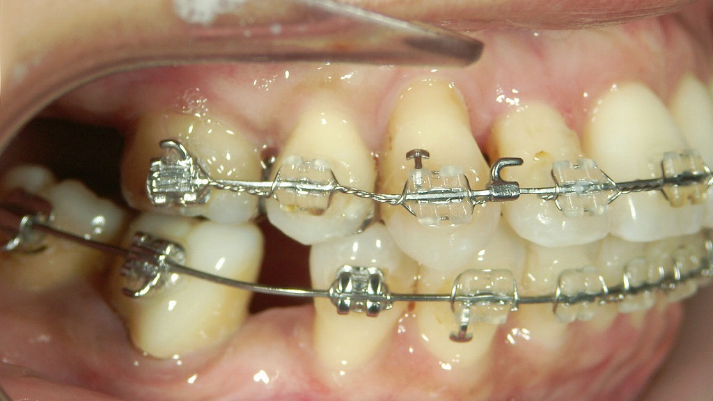 ブラケット矯正
