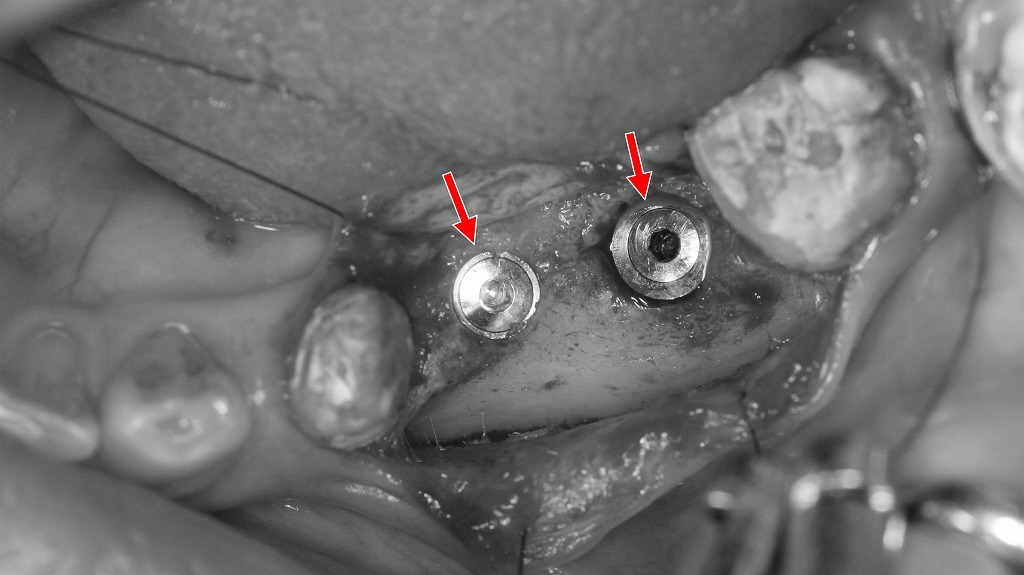 下顎5・6番部インプラント埋入完了 ― フィクスチャー設置直後の所見