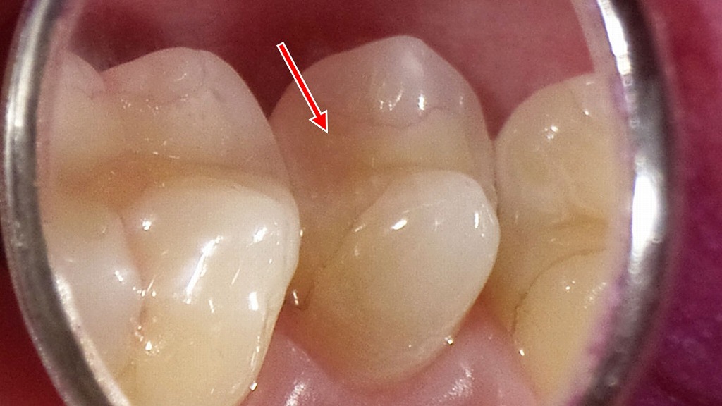 白いセラミックインレー(自費)