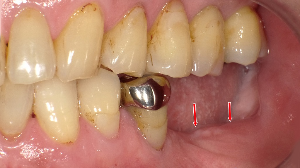 術前：左下６番・７番欠損症例