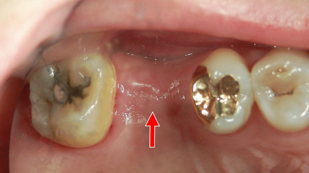 上顎6番欠損の状態（インプラント治療前）