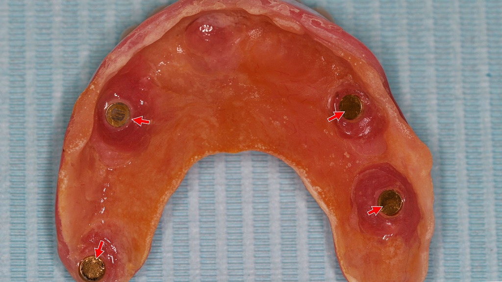 オーバーデンチャー内面に組み込まれた磁性アタッチメント