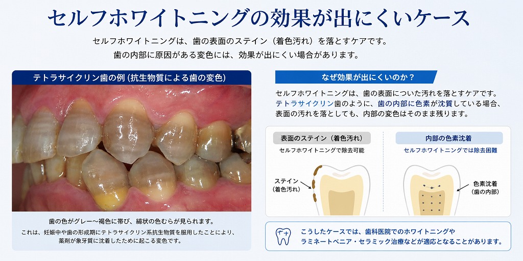 セルフホワイトニングの効果が出にくいケース