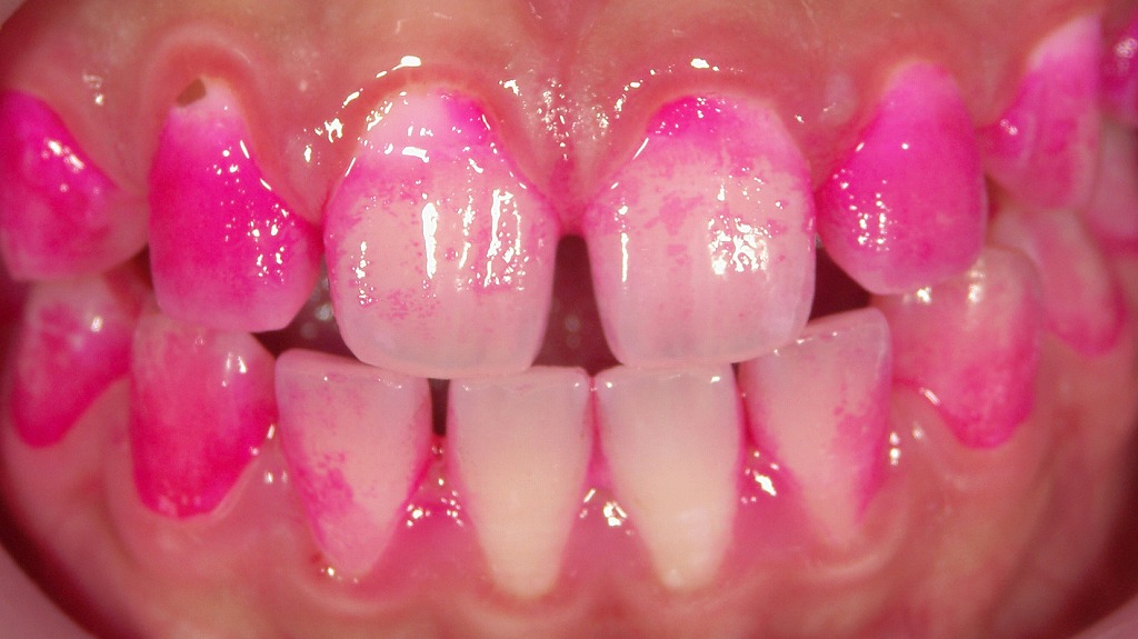 染め出し液による磨き残しチェック