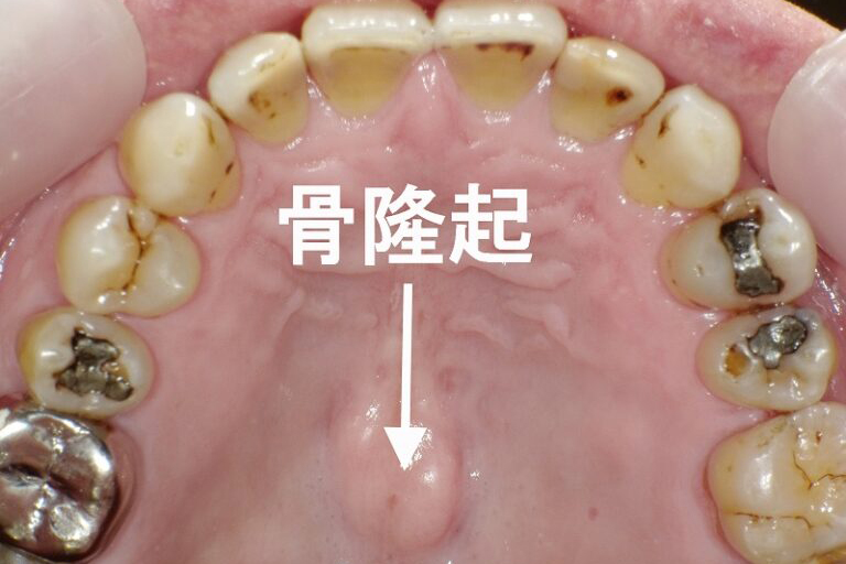 上顎中央に“上顎隆起（骨隆起）”が見られる状態。骨が盛り上がってできる良性の変化で、痛みはほとんどありません。