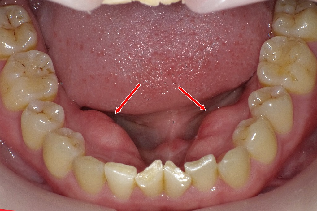 下顎内側に見られる“下顎隆起（骨隆起・外骨症）”。