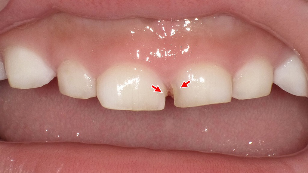 短期間で進行する乳歯の虫歯