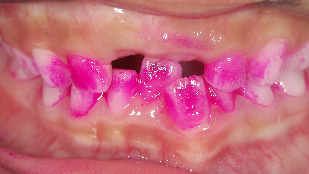 染め出しで分かる磨き残し