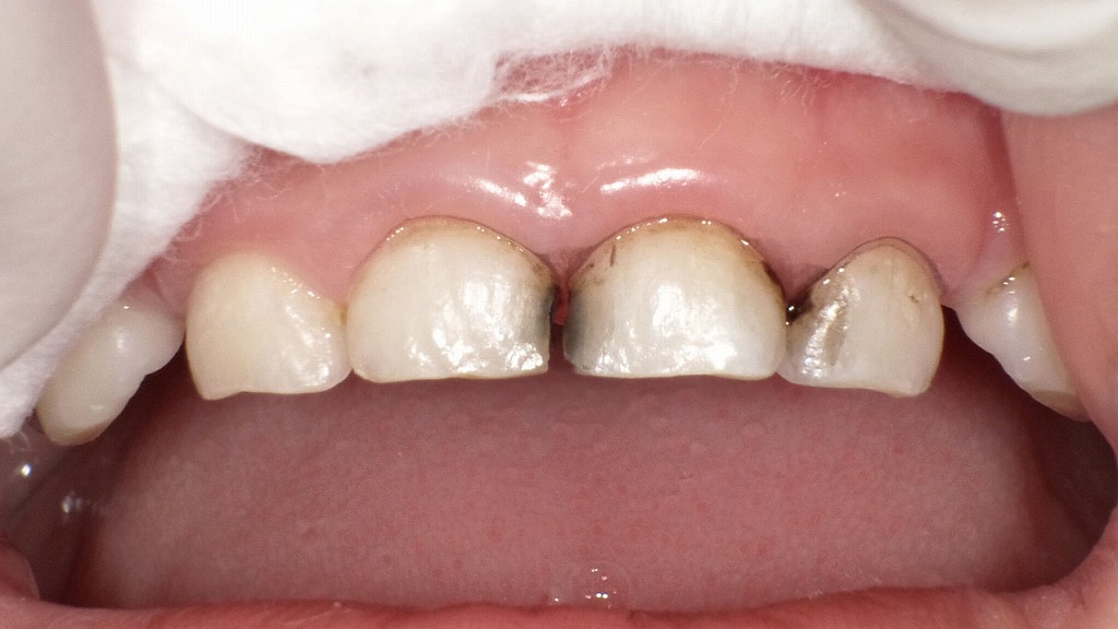 サホライド塗布