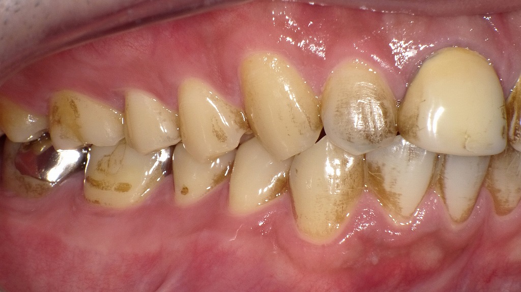 喫煙習慣による歯の着色｜短期間で進行するステインの付着