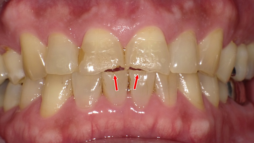 前歯の先端がわずかに欠けた状態。噛み合わせの負担や歯ぎしりで起こりやすいトラブルです。