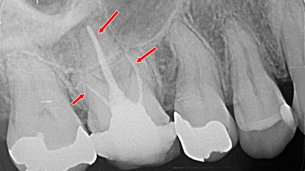 複雑な根管形態を正確に把握し、根尖まで緊密に封鎖された精密な根管治療