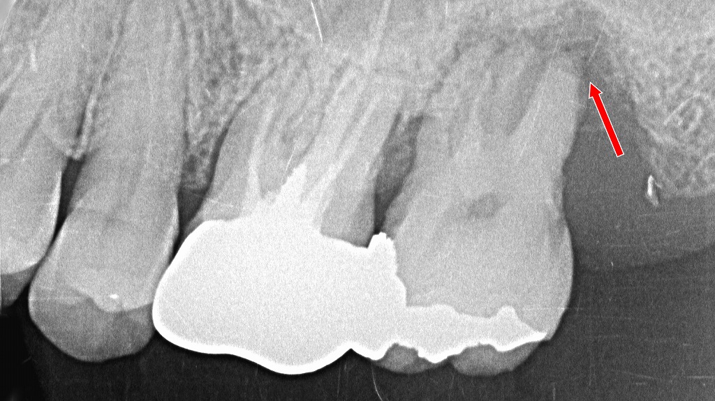 歯槽骨が根尖まで失われた重度歯周病：矯正治療が適応外となるケース