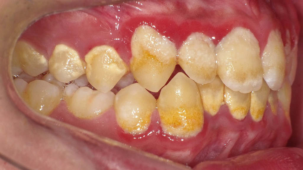 歯石形成の進行を示す症例