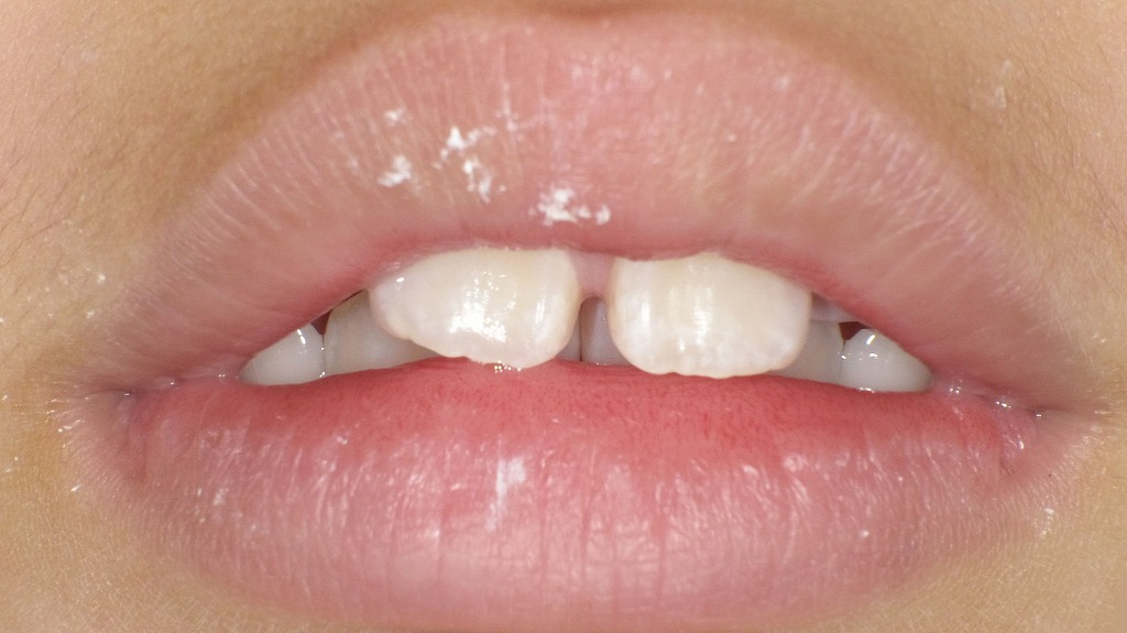 お口ポカンによる前歯の突出（アデノイド顔貌の初期サイン）