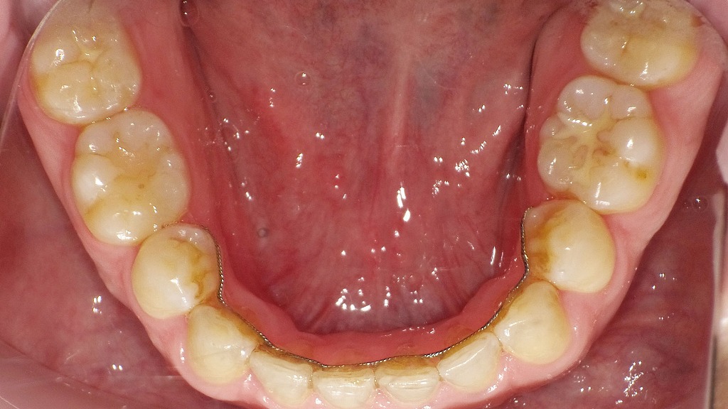 歯の裏に固定するフィックスリテーナー（固定式リテーナー）