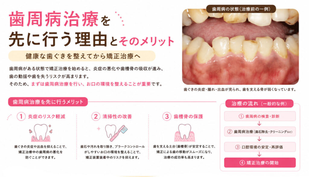 なぜ歯周病治療を先に行うの？