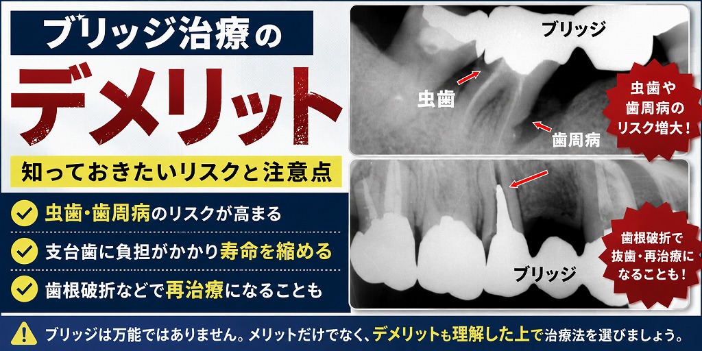ブリッジ治療のデメリット