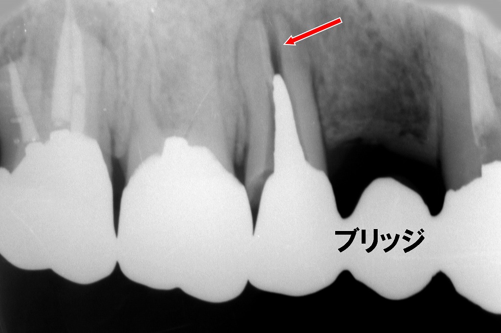 上顎3〜5番のブリッジ支台のうち、5番歯根に縦の破折線が認められます。破折歯は保存が困難で、抜歯が適応となる所見です。