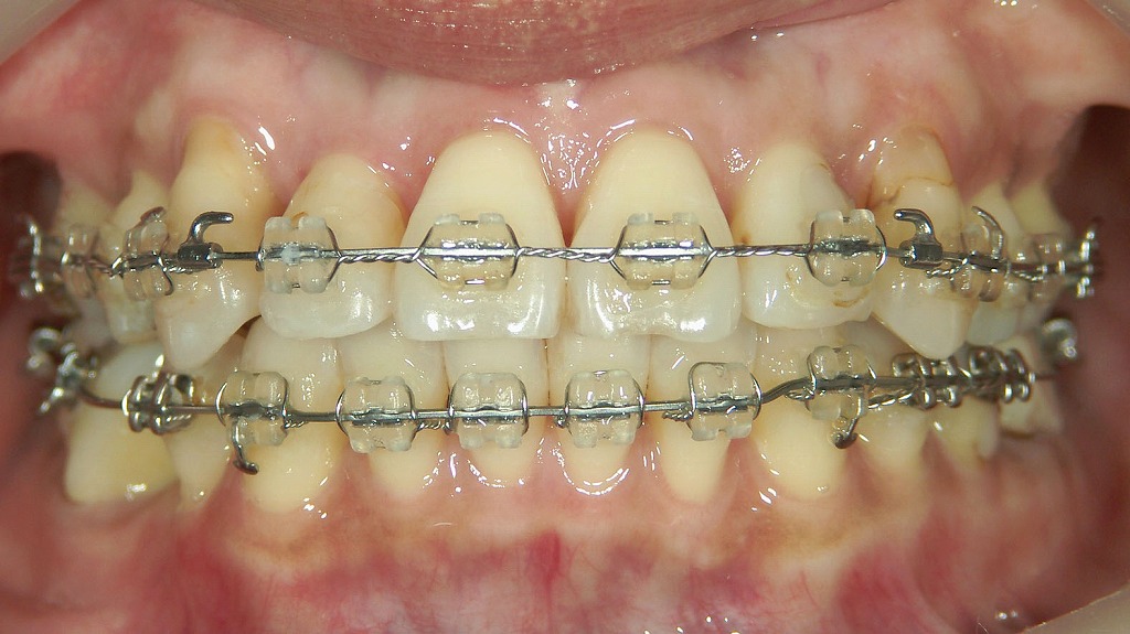 ワイヤー矯正（ブラケット矯正）