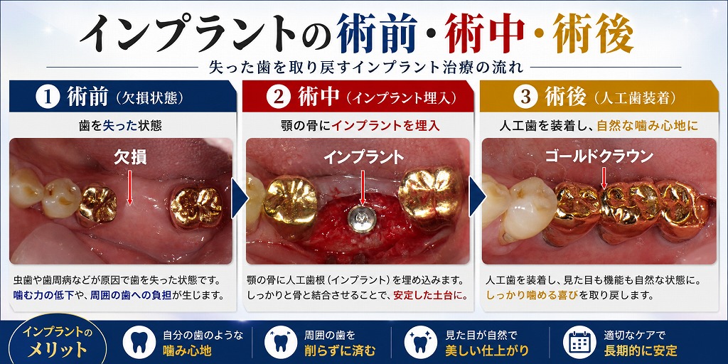 インプラントの術前・術中・術後