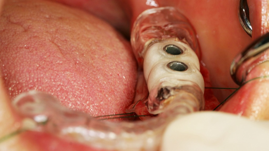 下顎5・6番部インプラント手術 ― サージカルガイド装着下での埋入準備