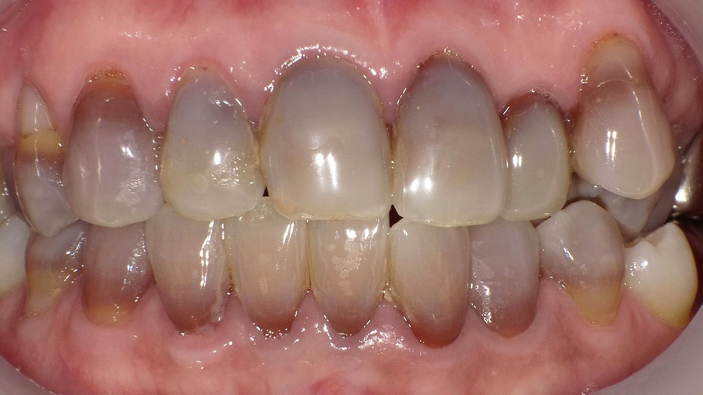 重度テトラサイクリン歯による広範な歯の変色(治療前)