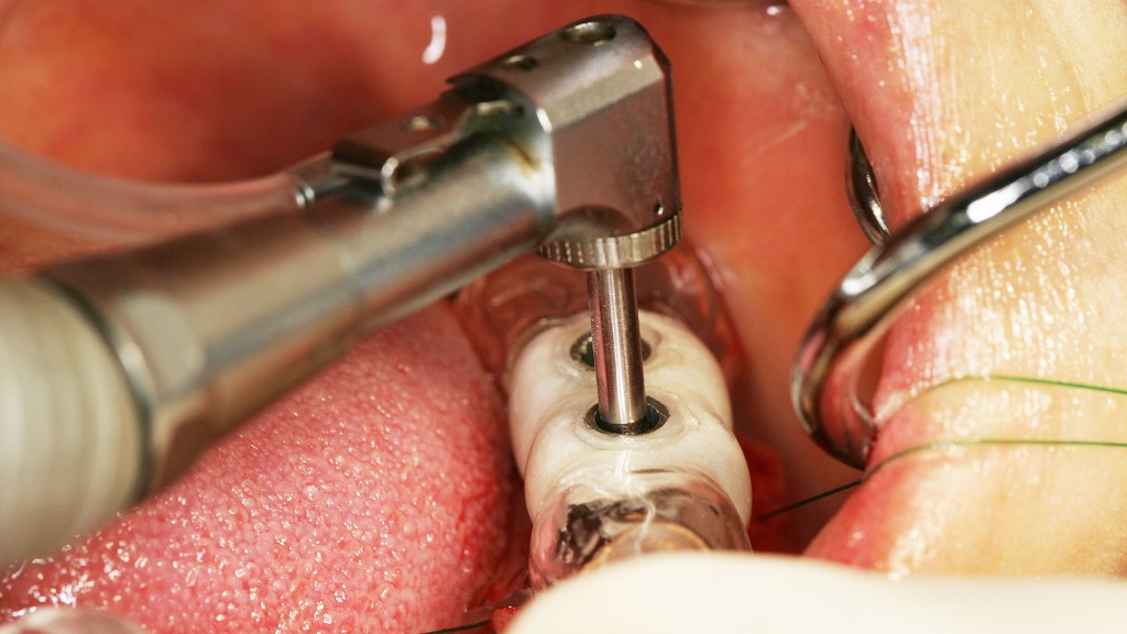 下顎5・6番部インプラント手術 ― サージカルガイド下でのドリリング操作