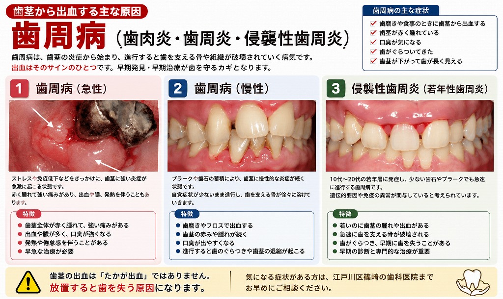 歯周病（歯肉炎・歯周炎・侵襲性歯周炎）