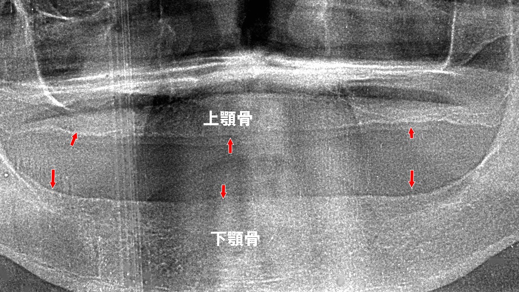 顎の骨の吸収（骨が痩せる）