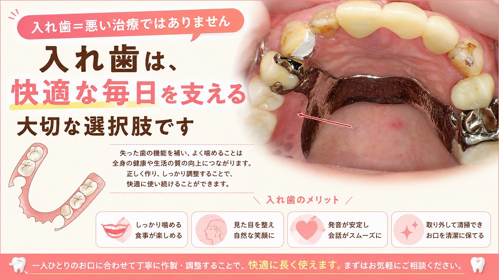 入れ歯＝悪い治療ではありません