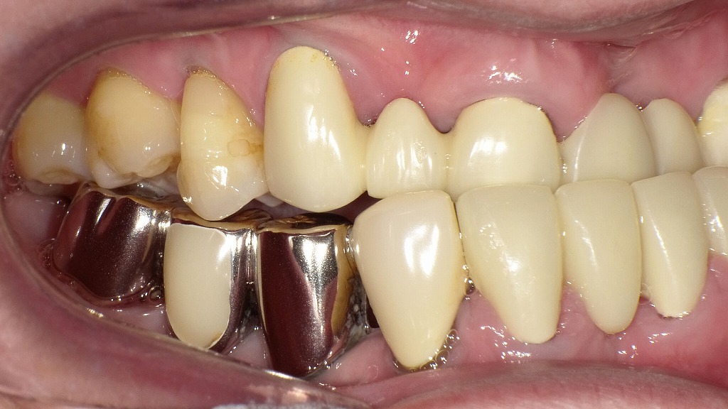 骨格性反対咬合（受け口）｜上下顎の骨格的ズレによる咬合異常（成人）