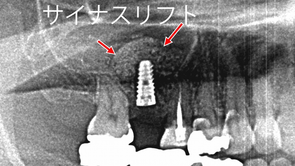 術後レントゲン：上顎６番相当部のインプラント埋入とサイナスリフト