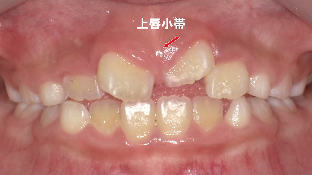 5か月後の上唇小帯の変化：自然に薄く・上方へ移動