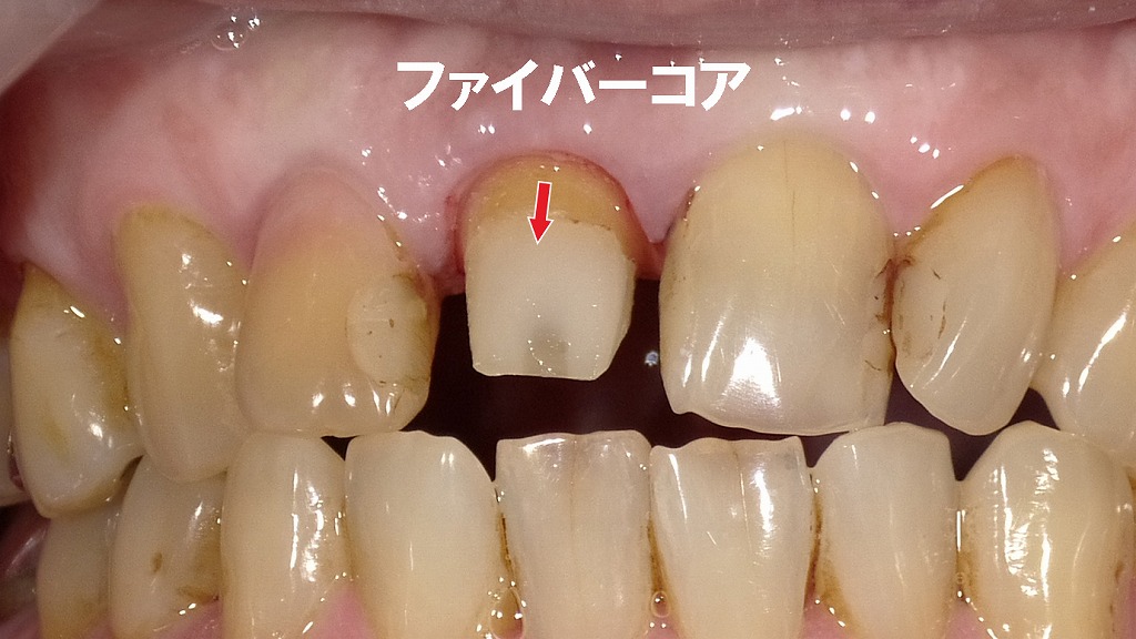 ファイバーコア