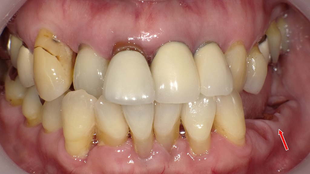 左下臼歯部（4・5・6・7番）に及ぶ重度虫歯（C4）の進行症例
